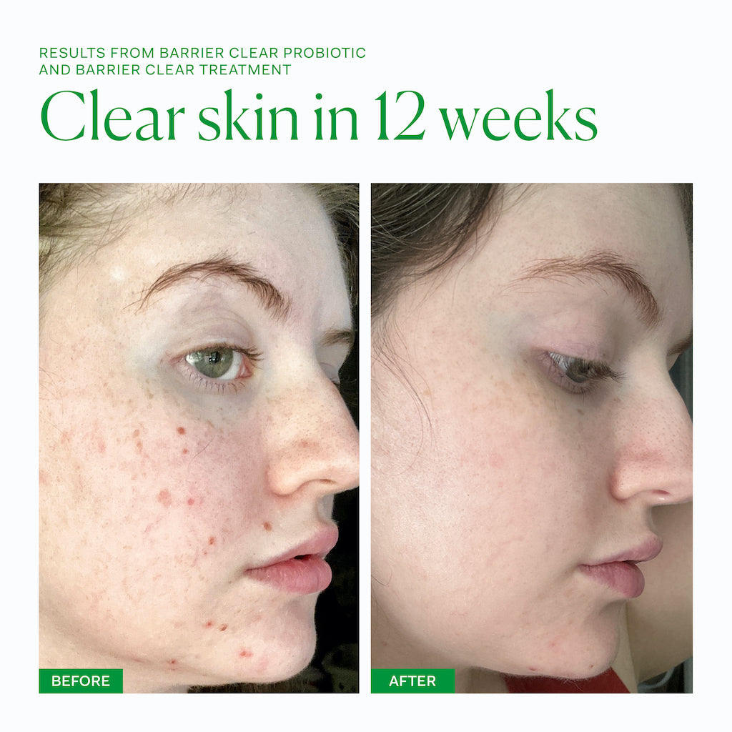 Barrier Clear Treatment 30ml